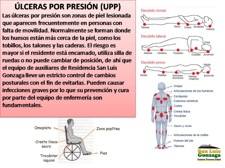 Que son ulceras por presion